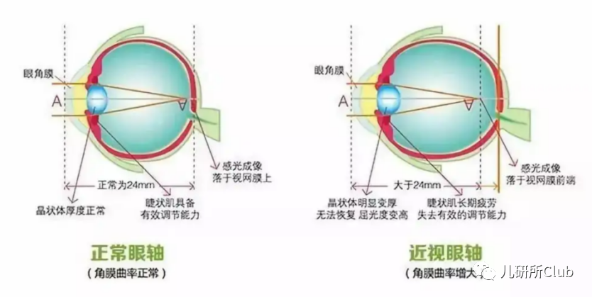 眼睛近视原理图图片